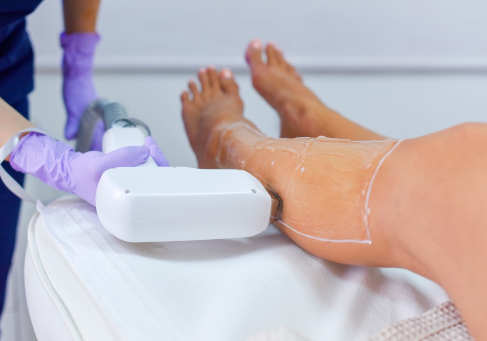 Trattamento di epilazione laser sulle gambe