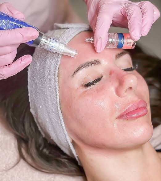 Trattamento microneedling sul viso